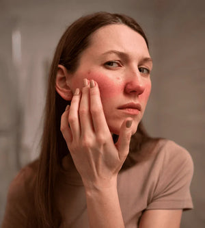 Consistent skin breakouts